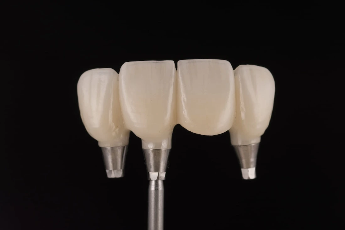 Zubné implantáty
